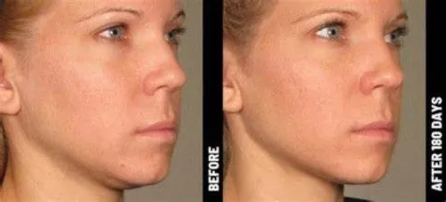 Ultherapy Eye