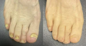 nail fungus laser treatment before and after