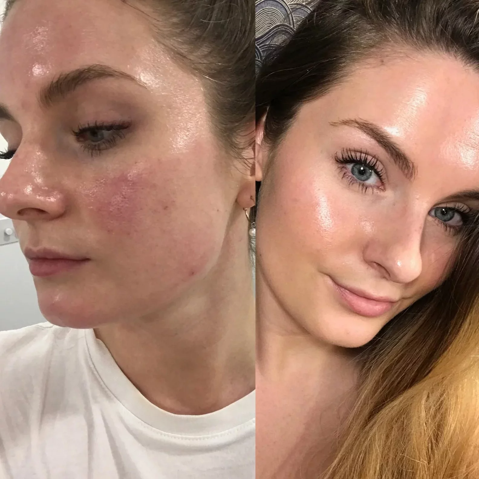 Broken blood vessels on face