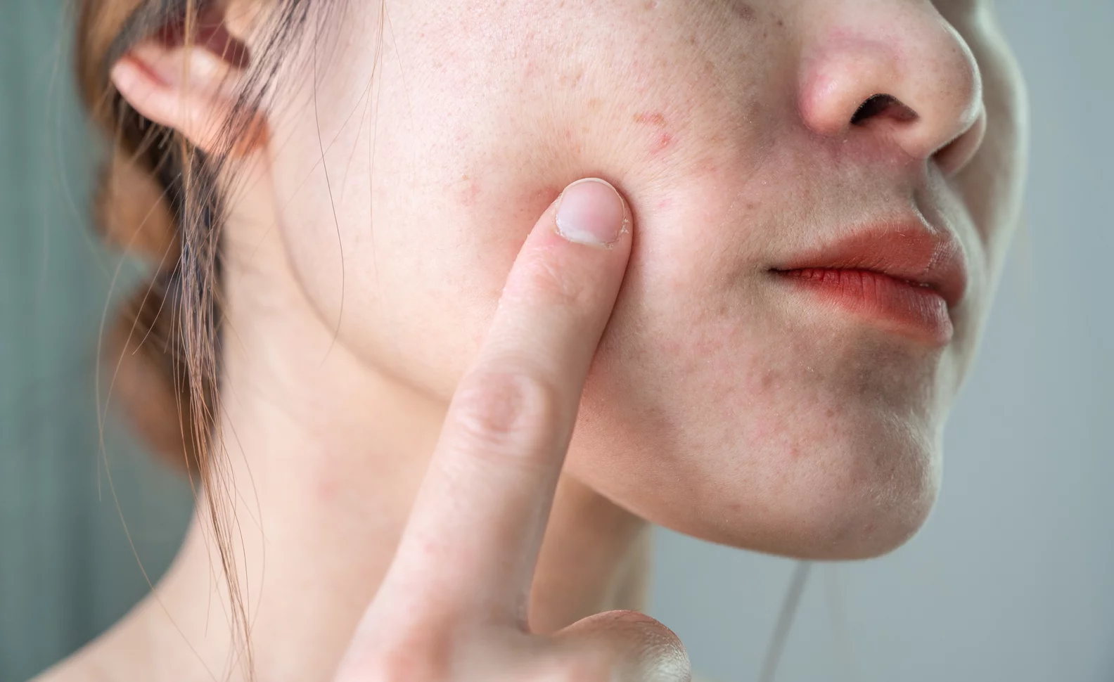 Broken blood vessels on face