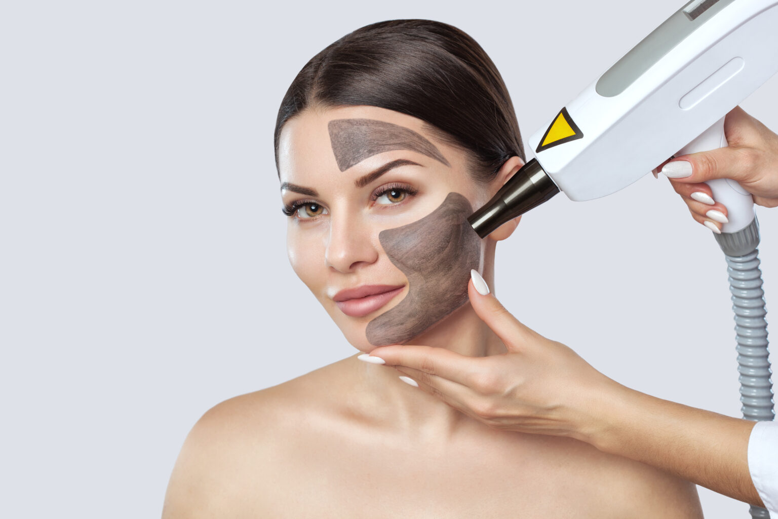 Carbon laser facial