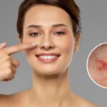 Spider veins on face treatment