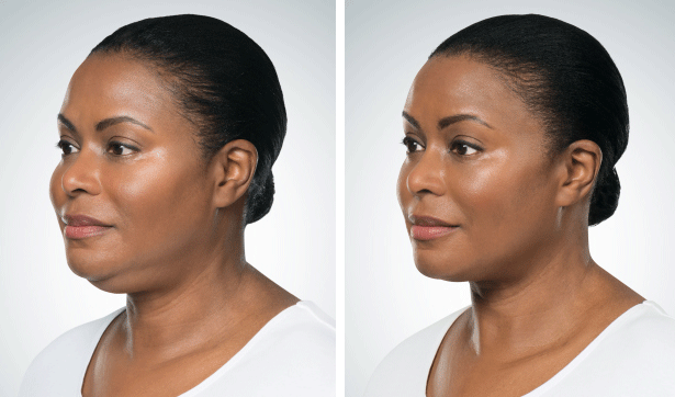 kybella
