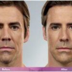 Masseter botox