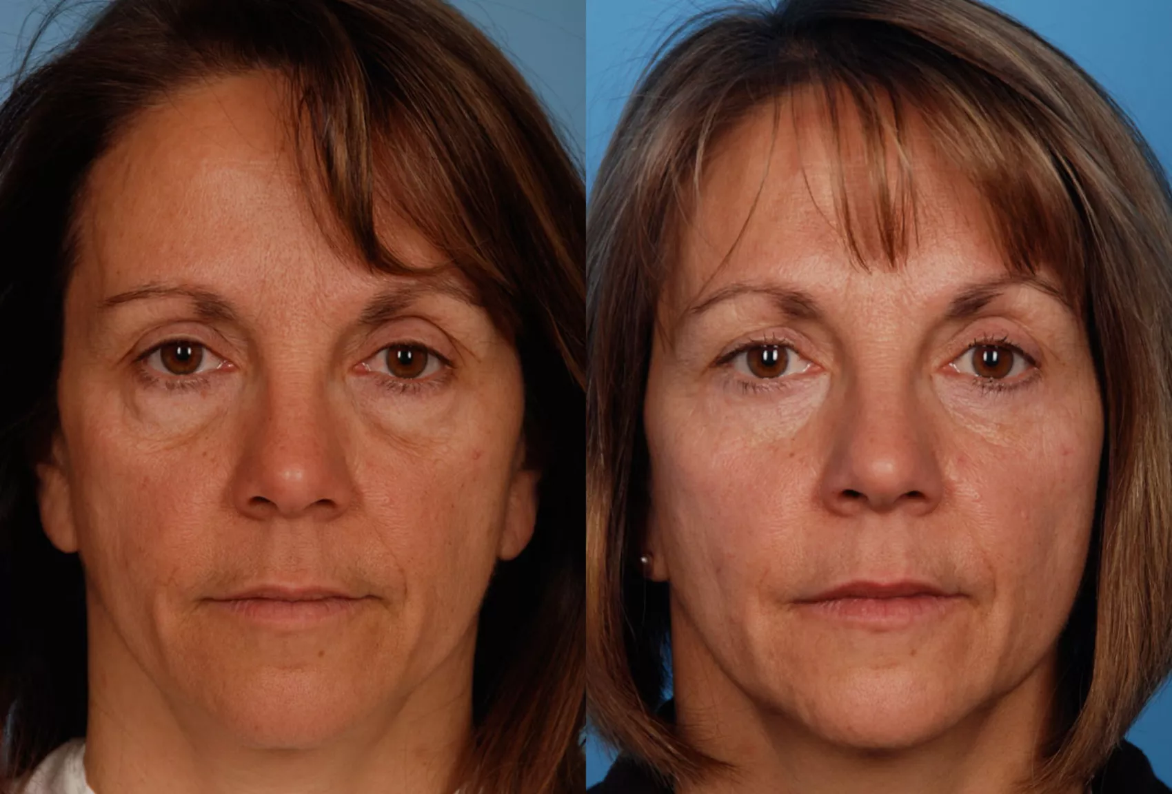 Blepharoplasty surgery near me