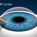 Presbyopia correction surgery