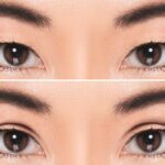 Double eye lid surgery