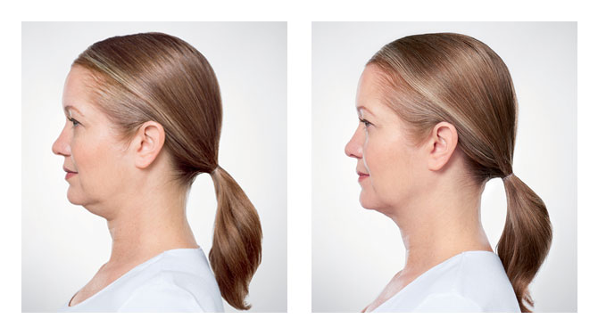 kybella