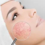 Broken blood vessels on face