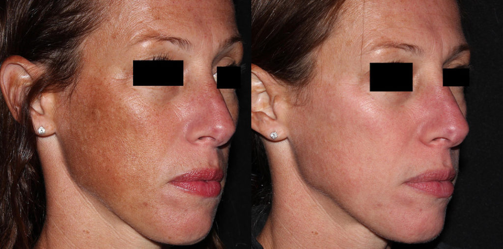 Picosure laser near me