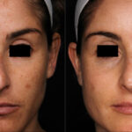 Picosure laser near me