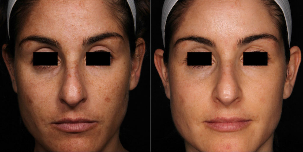 Picosure laser near me