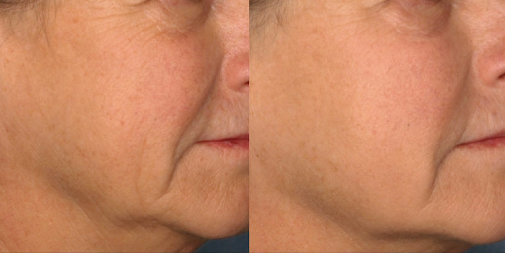 Picosure laser near me