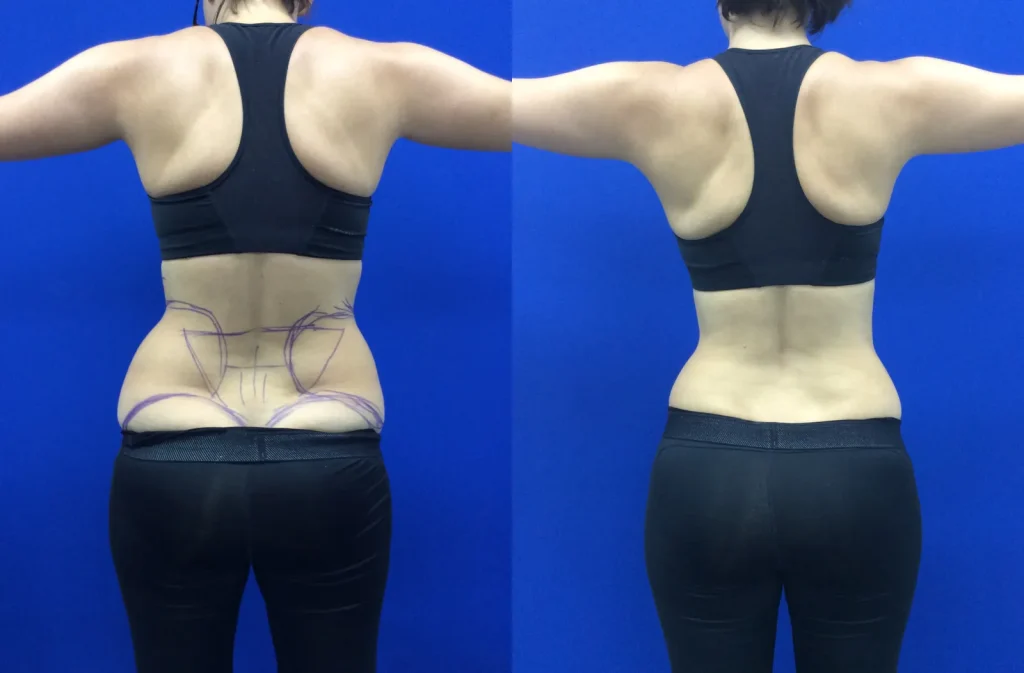 Laser liposuction