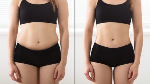 Laser liposuction
