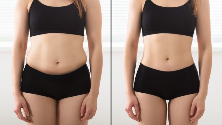 Laser liposuction