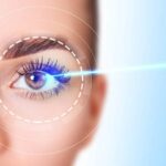 Lasik eye surgery