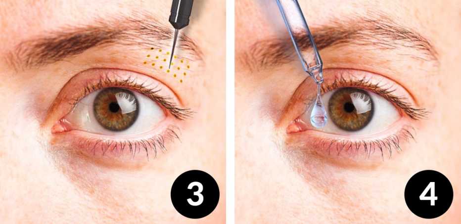 Eye Drops for Droopy Eyelids