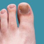 Toenail Fungus Treatment