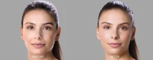 Mid face lift before and after results showing improved cheek contours