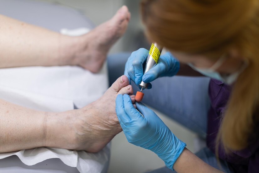 Pros and Cons of Laser Treatment for Toenail Fungus