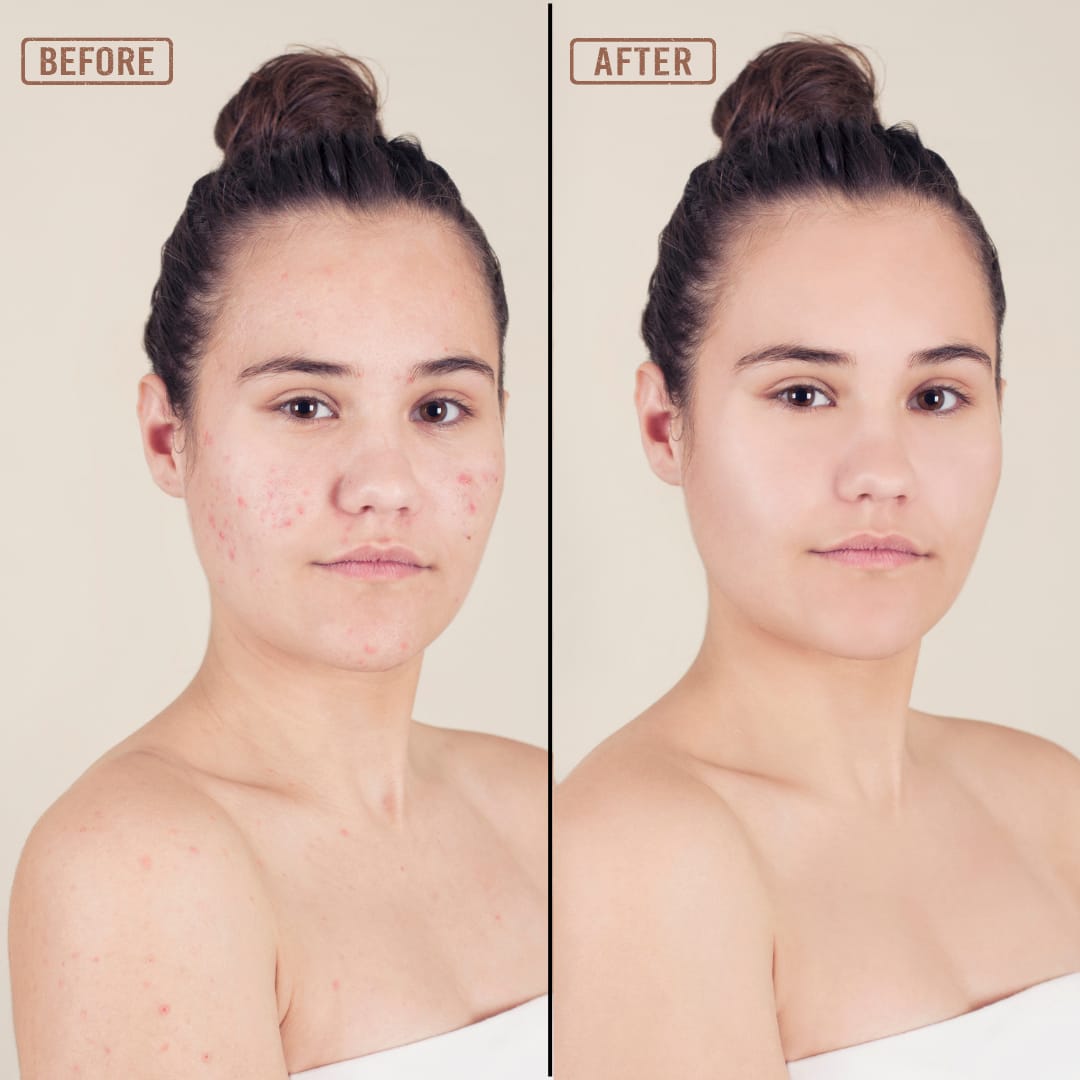 Best Body Cleanser for Acne