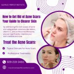 How to Get Rid of Acne Scars