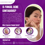 Is Fungal Acne Contagious