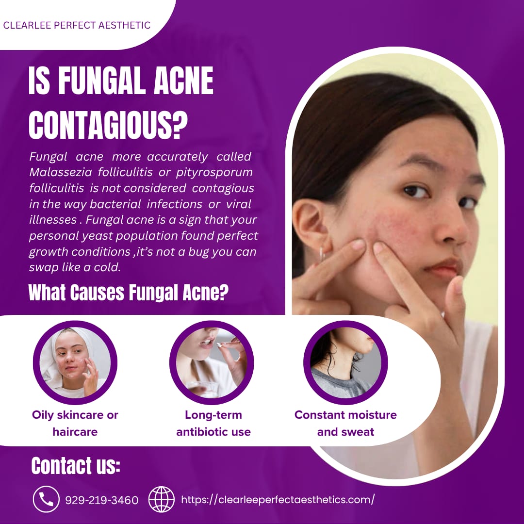 Is Fungal Acne Contagious
