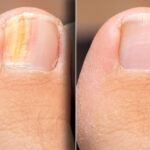 laser treatment for nail fungus near me procedure