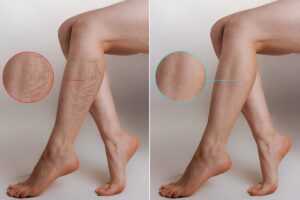 laser spider vein removal before and after results