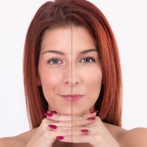 Enlarged Pores