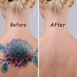 PicoSure Laser Tattoo Removal