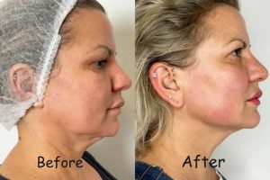what is endolift
