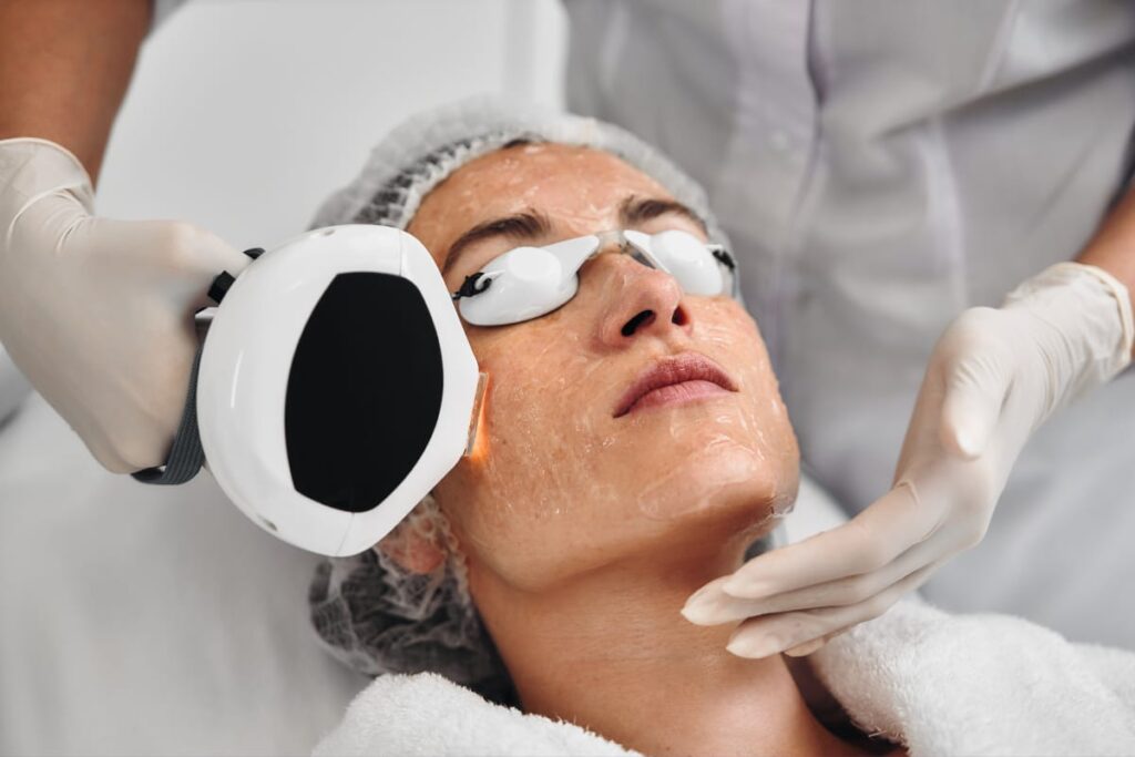 IPL Photofacial Benefits