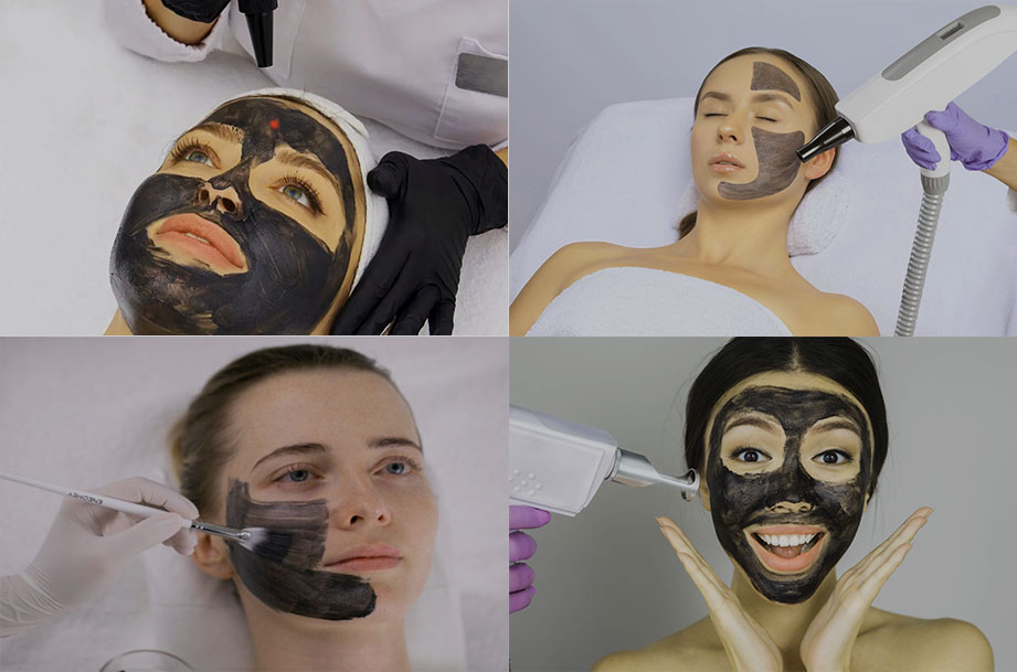 carbon laser peel in nyc