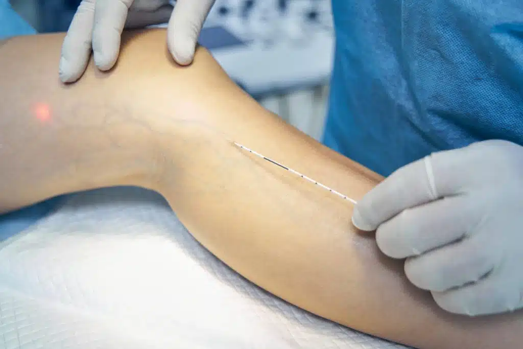Laser Spider Vein Removal