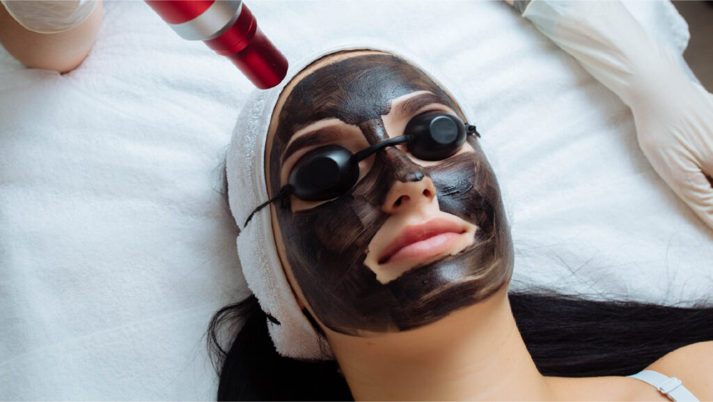 Laser Carbon Peel – The Ultimate Guide to Clear, Radiant Skin