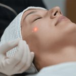 Endolift Treatment At Clearlee Perfect Aesthetics