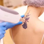 picosure laser tattoo removal At Clearlee Perfect Aesthetics