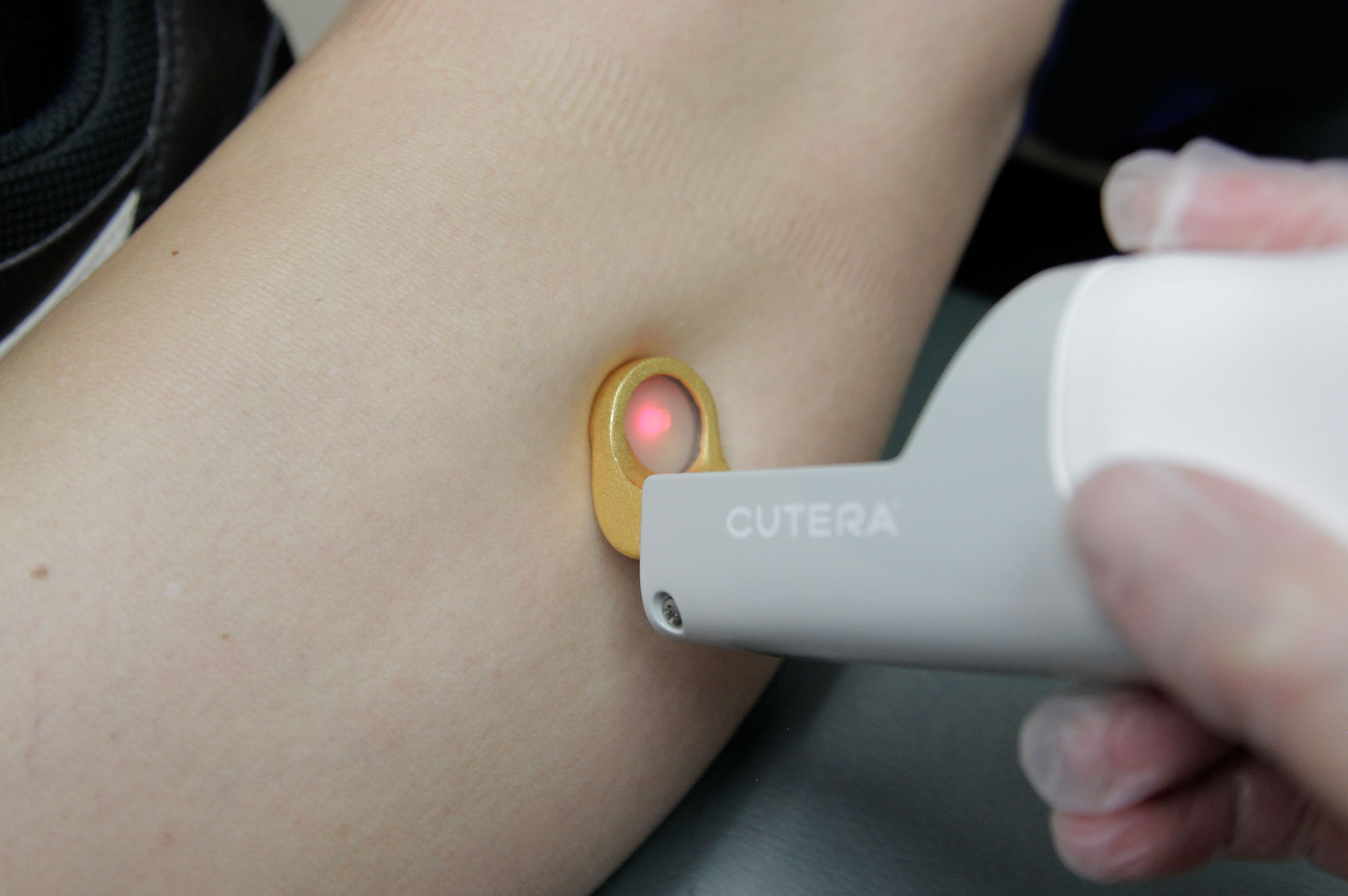 Laser Vein Removal New York I At Clearlee Perfect Aesthetics