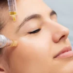 prp therapy for face At Clearlee Perfect Aesthetics