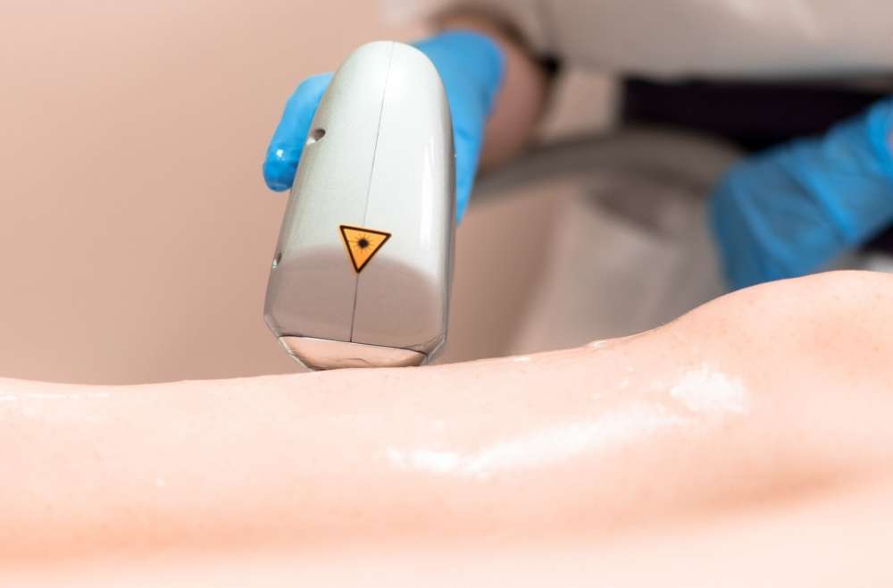 Spider Vein Removal Laser At Clearlee Perfect Aesthetics