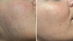 Before and after laser hair removal results