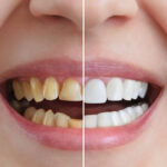 cosmetic dentistry services smile transformation before after