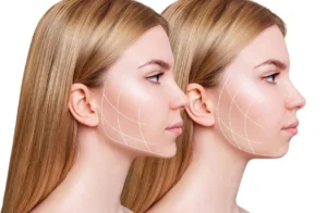 Jawline Filler Before and After