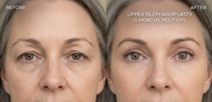 Side-by-side comparison showing rejuvenated upper eyelids after blepharoplasty surgery.