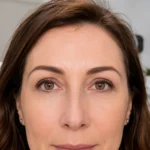 Upper blepharoplasty natural-looking eyelid rejuvenation result in clinical setting