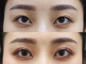 Upper eyelid surgery before and after open eye enhancement