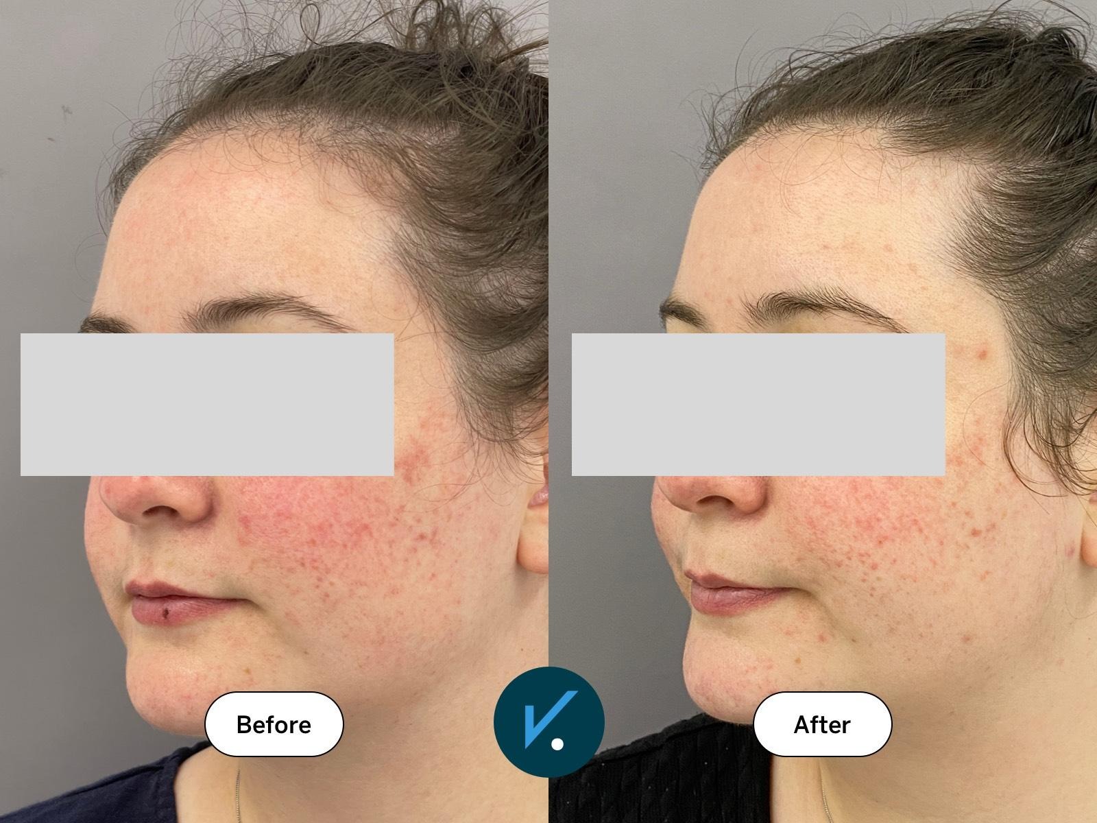 ipl laser for rosacea before and after results showing reduced redness and clearer skin